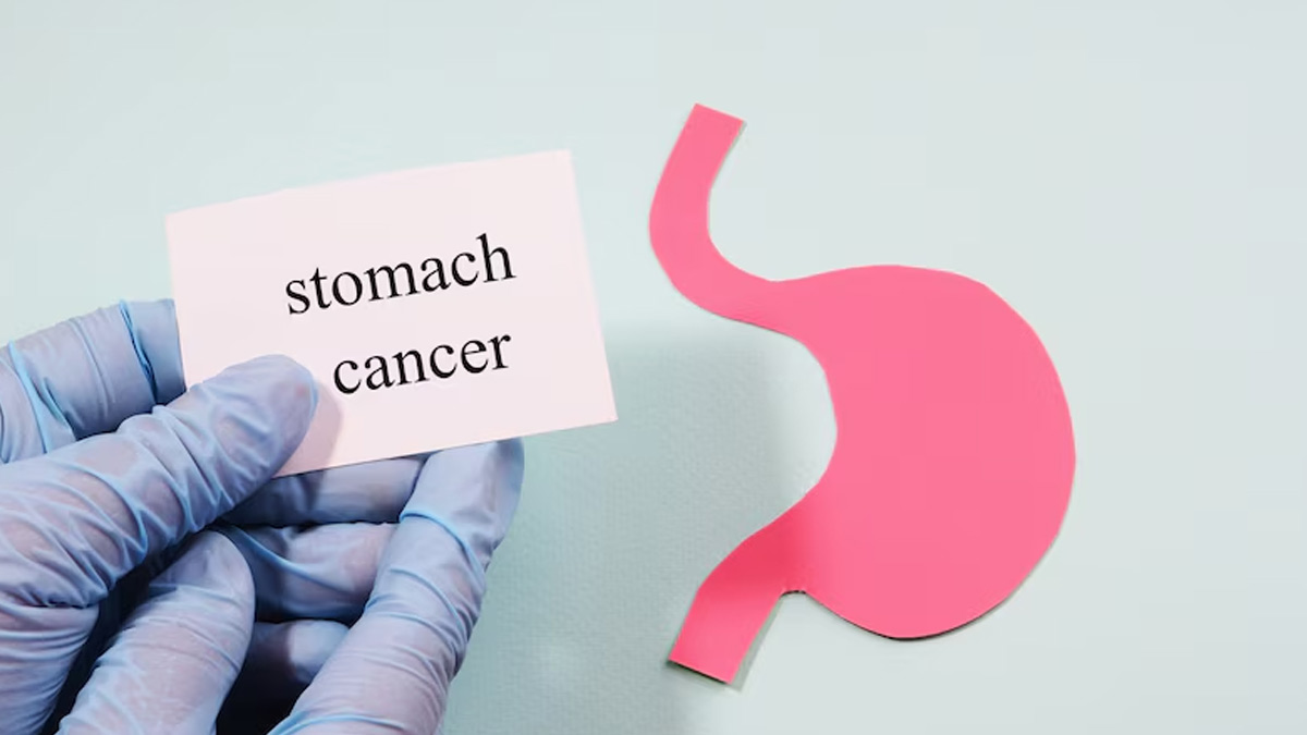 Stomach Cancer